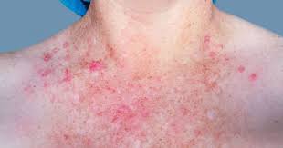 Image result for scabies in the groin area
