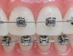 But braces and orthodontic work can be expensive, and some insurance companies view braces as just a cosmetic procedure that is not necessary. Damon Braces Orthodontics The James Clinic