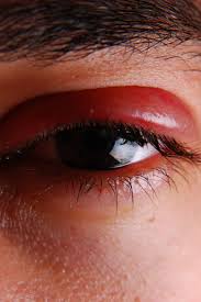 Cat sneezing can be triggered by anything that irritates your cat's nose, such as cigarette smoke, air freshener, or allergies. Shingles In The Eye Symptoms Treatment And Prevention