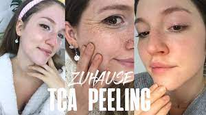 Beim fruchtsäurepeeling handelt es sich um ein oberflächliches, chemisches peeling. Anleitung Tca Peeling Fur Zuhause Ein Neues Gesicht Youtube