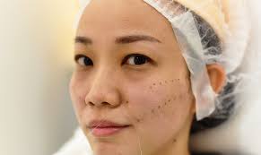شد الوجه بالخيوط قبل وبعد مميزات نصائح و اضرار شد الوجه بالخيط بشرة وشعر Thread Lift Face Baby Face Facelift