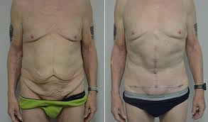 Arm motion following arm lift surgery; Abdominoplasty Patient 114 Jonathan Hall Md Facsjonathan Hall Md Facs