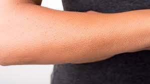 Bahaya kanser limfoma fit mummy for life. Pasien Kanker Limfoma Non Hodgkin Bisa Sembuh Asal Health Liputan6 Com