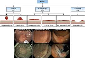 Everyone should consider checking their stools regularly to look out for any of the four key warning signs. Endoscopic Removal Of Colorectal Lesions Recommendations By The Us Multi Society Task Force On Colorectal Cancer Gastrointestinal Endoscopy