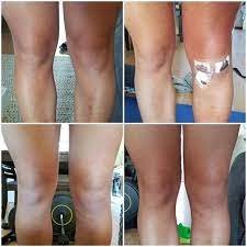 It can be a complication of knee replacement or anterior cruciate ligament surgery, with infections and bleeding as known contributing factors. Facebook