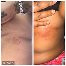 Image result for Candidiasis under breasts