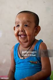 206 Progeria Stock Photos, High-Res Pictures, and Images