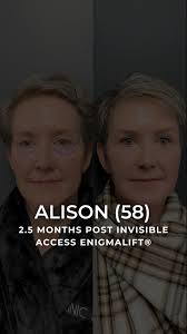Dry eyes and eyelid surgery👁️ Everything you need to know, Plus, a 2.5  month follow up for Alison after her EnigmaLift®️, Alison had a big concern  about eyelid surgery for years before this procedure ...