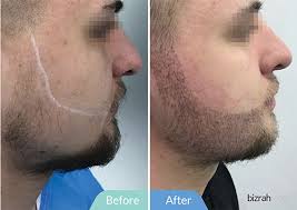 That's a lot of money. Beard Transplant Before After Pictures Bizrahmed Dubai Uae