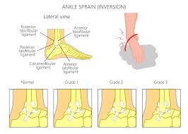 This occurs typically when the foot is in a position of being pointed down and turned inwards. Sprained Ankle Are They All The Same Evolve Sports Physio