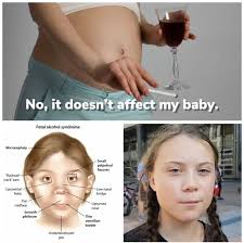 We did not find results for: No It Doesn T Affect My Baby Fetal Alcohol Syndrome Microcephaly Small Palpebral Fissures Railroad Track Ears Low Nasal Epicanthal Folds Bridge Folds Flat Midface Upturned Nose Nose Smooth Philtrum Thin Vermilion Border