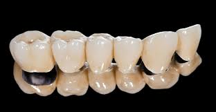 Alle Infos Zu Zahnbrucken Auf Einen Blick Gelencser Dental Magazin