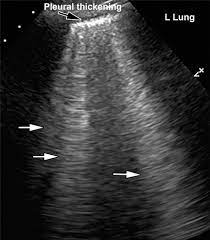 Một số phụ nữ có giọng khàn khiến đấng mày râu mê mẩn. Multisystem Imaging Manifestations Of Covid 19 Part 1 Viral Pathogenesis And Pulmonary And Vascular System Complications Radiographics