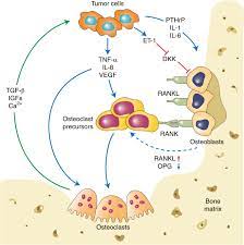 Molecular Mechanisms And Clinical Management Of Cancer Bone Metastasis Bone Research