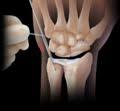 Zu einer ruptur der aorta kann es entweder durch fortschreitende veränderungen in der gefäßwand (z.b. Arthrex Tfcc Triangular Fibrocartilage Complex Triangularer Fibrokartilaginarer Komplex