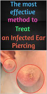 The Most Effective Method To Treat An Infected Ear Piercing Infected Ear Piercing Ear Piercings Home Remedies Beauty