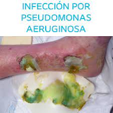 Manejo Del Exudado En Las Ulceras Venosas Menos Dias Con Heridas