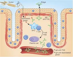 Federation of international societies of pediatric gastroenterology, hepatology, and nutrition consensus of report on celiac disease /j. Diagnosis And Treatment Of Celiac Disease Mucosal Immunology