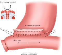 Colonic resection with primary anastomosis and defunctioning ileostomy. Fundamentals Of Gastrointestinal Anastomoses Springerlink