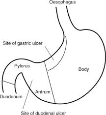 Peptic Ulcer An Overview Sciencedirect Topics