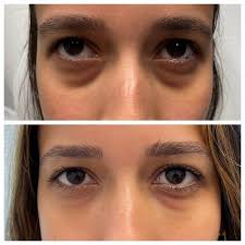 How Much Does Eye Lift Surgery Cost?