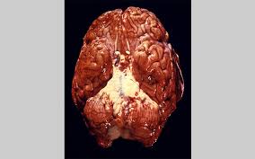 Pneumococcal meningitis occurs when the bacteria that have invaded the bloodstream move across to infect the 'meninges' (the membranes that surround and protect the brain and spinal cord). Pneumococcal Disease Photos Cdc
