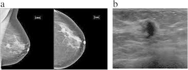 Major improvements in public health and medical care have resulted in dramatic increases in longevity. 48 Year Old Woman With Positive Family History For Breast Cancer Download Scientific Diagram