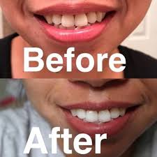 About 30 minutes after finishing your coffee, rinse your mouth out with water or brush your teeth to remove the pigments from your enamel. 20 Teeth Whiteners That Work So Well It S Like Magic