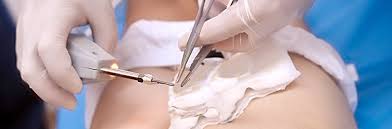 O umflatura in zona inghinala, insotita de o durere usoara, acestea sunt semnele unei hernii interventia laparoscopica se realizeaza prin 3. Sanador Operatie Fimoza Chirurgie Moderna