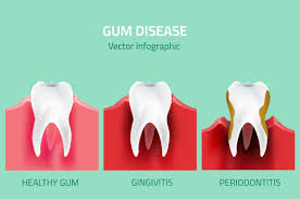 What's so great about gums? How Does Gum Disease Affect Your Overall Health