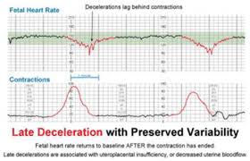 Image result for Late Deceleration