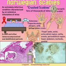 Image result for scabies norvegica