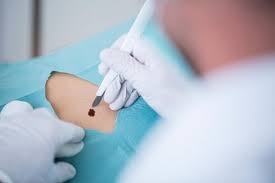 Ambulante Operationen Dermatologie Hoch 2