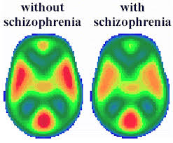 Explore and share the best schizophrenia gifs and most popular animated gifs here on giphy. 42 Schizophrenia Ideas Schizophrenia Mental Disorders Psychiatry