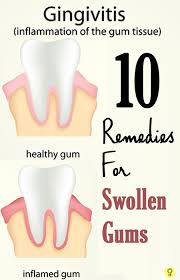 14 Home Remedies To Treat Swollen Gums Causes And Prevention Gum Health Swollen Gum Teeth Health