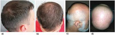 One very reputable clinic said this. Evaluation Of Patients With Alopecia Intechopen