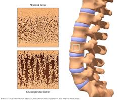 bone density test mayo clinic