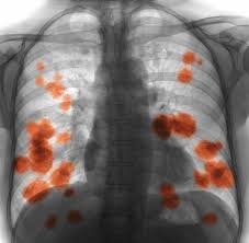 What does cancer look like in the throat? A Closer Look At The Top 5 Deadliest Cancers