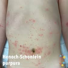 However, they commonly appear in clusters. Henoch Schonlein Purpura Skin Deep