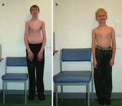 Marfan Syndrome And Related Disorders Springerlink