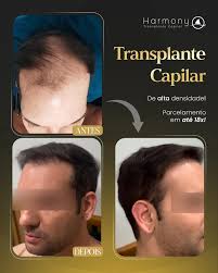 Harmony Transplante Capilar (@harmonytransplante.santos) • Instagram photos  and videos