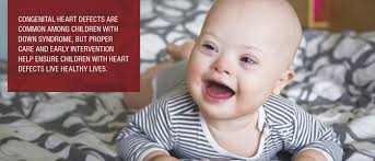 Congenital Heart Defects And Down Syndrome What Parents Should Know Global Down Syndrome Foundation