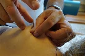 Dry Needling Main Line Health Philadelphia Pennsylvania