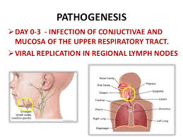 Chickenpox Ppt