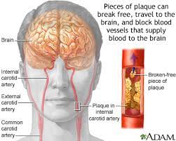 There are two internal carotid arteries in total, one on each side of the neck. Angioplasty And Stent Placement Carotid Artery Medlineplus Medical Encyclopedia