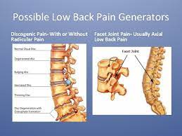 Primary Care Management Of The Degenerative Spine Jim