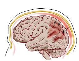 This leads to scarring of the neurological tissue in the brain and. Ocrelizumab The First Treatment For Primary Progressive Multiple Sclerosis Science In The News