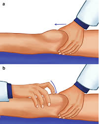 Image result for Ballottable Patella Sign