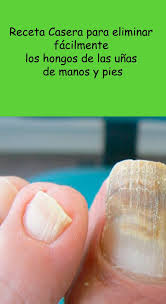 Hongos En Las Uñas De Las Manos Como Eliminarlos Como Eliminar Los Hongos De Manos Y Pies Remedio Hongos Pies Remedios Para Hongos En Los Pies Remedio Para Hongos