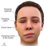 bell's palsy (FACE STROKE) from my.clevelandclinic.org